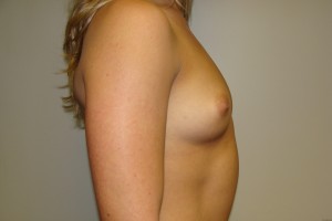 Breast Augmentation Before and After 248 | Sanjay Grover MD FACS