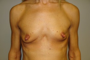 Breast Augmentation Before and After | Grover Aesthetics