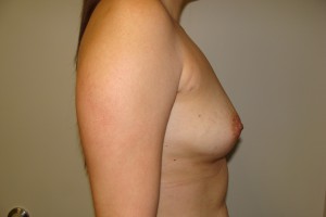 Breast Augmentation Before and After 250 | Grover Aesthetics