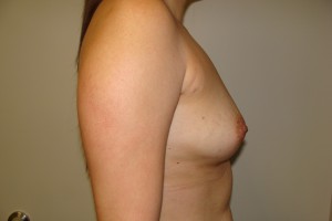 Breast Augmentation Before and After 250 | Sanjay Grover MD FACS