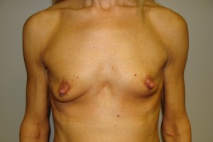 Breast Augmentation Before and After | Grover Aesthetics