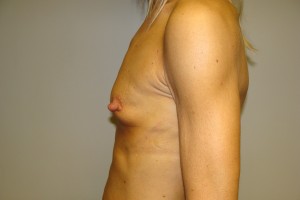 Breast Augmentation Before and After 251 | Grover Aesthetics