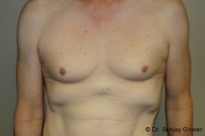 Breast Augmentation Before and After | Grover Aesthetics