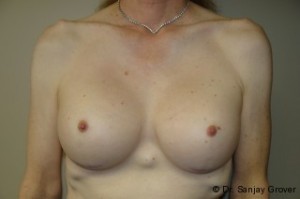 Breast Augmentation Before and After 252 | Sanjay Grover MD FACS