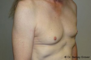 Breast Augmentation Before and After 252 | Grover Aesthetics
