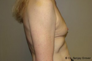 Breast Augmentation Before and After 252 | Sanjay Grover MD FACS