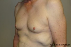 Breast Augmentation Before and After 252 | Grover Aesthetics