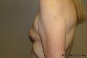 Breast Augmentation Before and After 252 | Grover Aesthetics