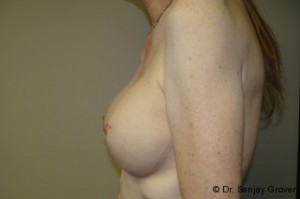 Breast Augmentation Before and After 252 | Grover Aesthetics