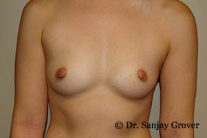 Breast Augmentation Before and After | Grover Aesthetics