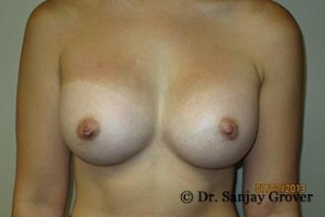 Breast Augmentation Before and After | Grover Aesthetics
