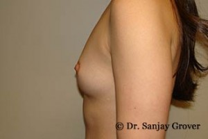 Breast Augmentation Before and After 253 | Sanjay Grover MD FACS