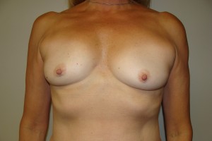 Breast Augmentation Before and After | Grover Aesthetics