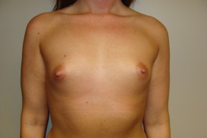Breast Augmentation Before and After | Grover Aesthetics