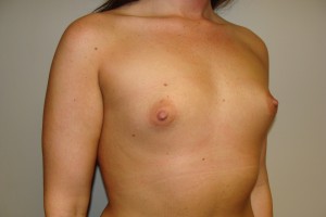 Breast Augmentation Before and After 255 | Grover Aesthetics