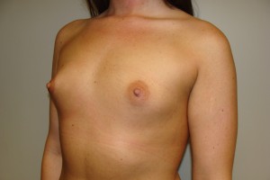 Breast Augmentation Before and After 255 | Grover Aesthetics