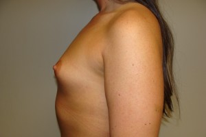Breast Augmentation Before and After 255 | Grover Aesthetics