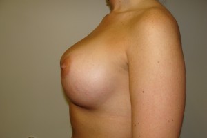 Breast Augmentation Before and After 255 | Grover Aesthetics