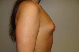 Breast Augmentation Before and After 255 | Grover Aesthetics