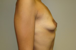 Breast Augmentation Before and After 256 | Grover Aesthetics