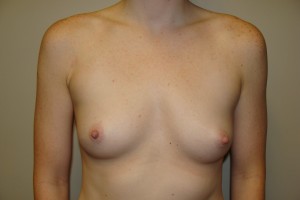 Breast Augmentation Before and After | Grover Aesthetics