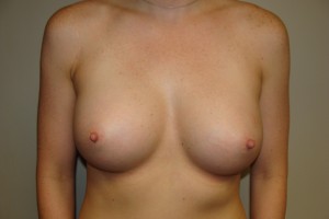 Breast Augmentation Before and After 257 | Sanjay Grover MD FACS