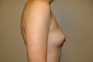 Breast Augmentation Before and After 257 | Grover Aesthetics