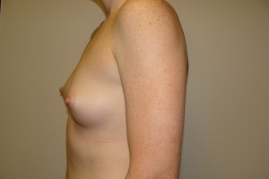 Breast Augmentation Before and After 257 | Grover Aesthetics