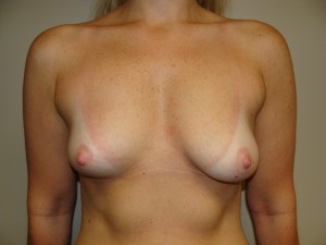 Breast Augmentation Before and After 233 | Sanjay Grover MD FACS