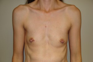 Breast Augmentation Before and After | Grover Aesthetics