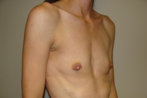 Breast Augmentation Before and After 258 | Grover Aesthetics