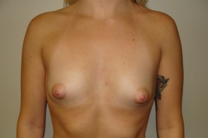Breast Augmentation Before and After | Grover Aesthetics