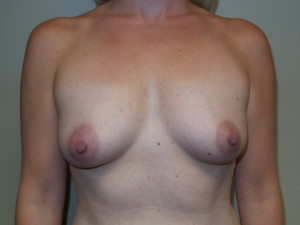 Breast Augmentation Before and After 250 | Sanjay Grover MD FACS