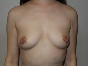 Breast Augmentation Before and After | Grover Aesthetics