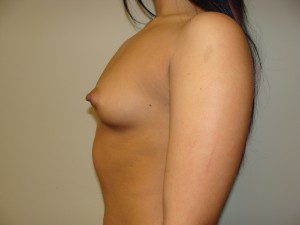 Breast Augmentation Before and After 261 | Sanjay Grover MD FACS