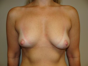 Breast Augmentation Before and After | Grover Aesthetics