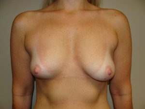 Breast Augmentation Before and After 53 | Sanjay Grover MD FACS