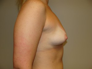Breast Augmentation Before and After 262 | Grover Aesthetics