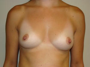 Breast Augmentation Before and After | Grover Aesthetics