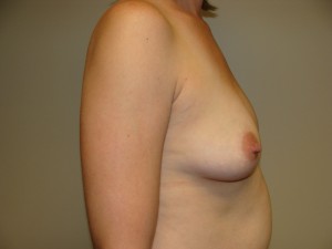 Breast Augmentation Before and After 264 | Grover Aesthetics