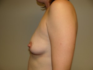 Breast Augmentation Before and After 264 | Grover Aesthetics