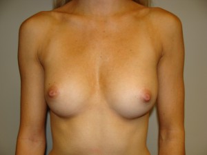 Breast Augmentation Before and After | Grover Aesthetics