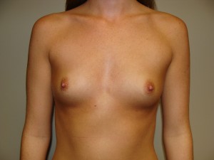 Breast Augmentation Before and After | Grover Aesthetics