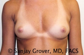 Breast Augmentation Before and After | Grover Aesthetics
