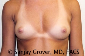 Breast Augmentation Before and After | Sanjay Grover MD FACS