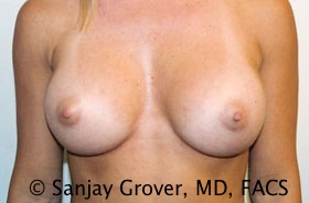 Breast Augmentation Before and After | Sanjay Grover MD FACS