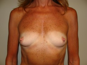 Breast Augmentation Before and After | Grover Aesthetics