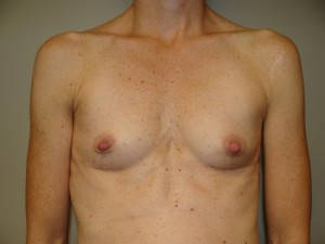 Breast Augmentation Before and After | Grover Aesthetics