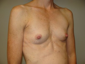 Breast Augmentation Before and After 272 | Grover Aesthetics