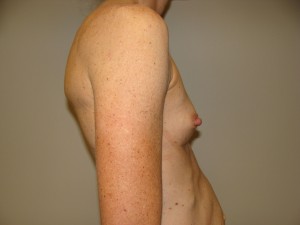 Breast Augmentation Before and After 272 | Grover Aesthetics